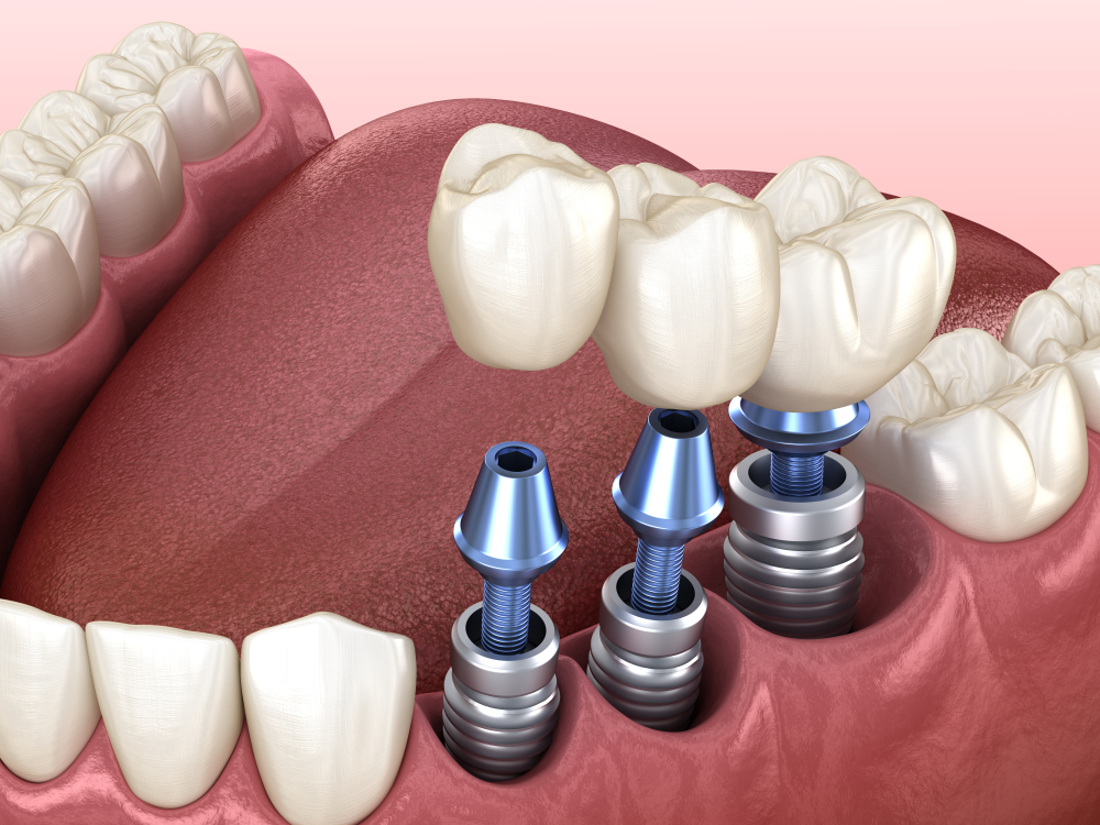illustration of dental implants Omaha, NE & Chalco, NE